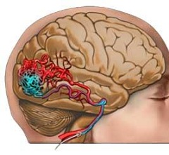 Гипертензия и головные боли симптомы ангиомы головного мозга